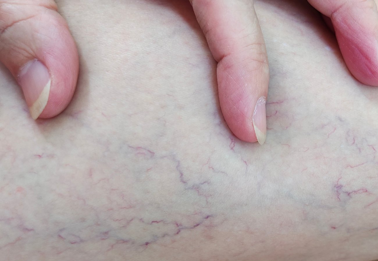 Κιρσοί Φλεβίτιδα