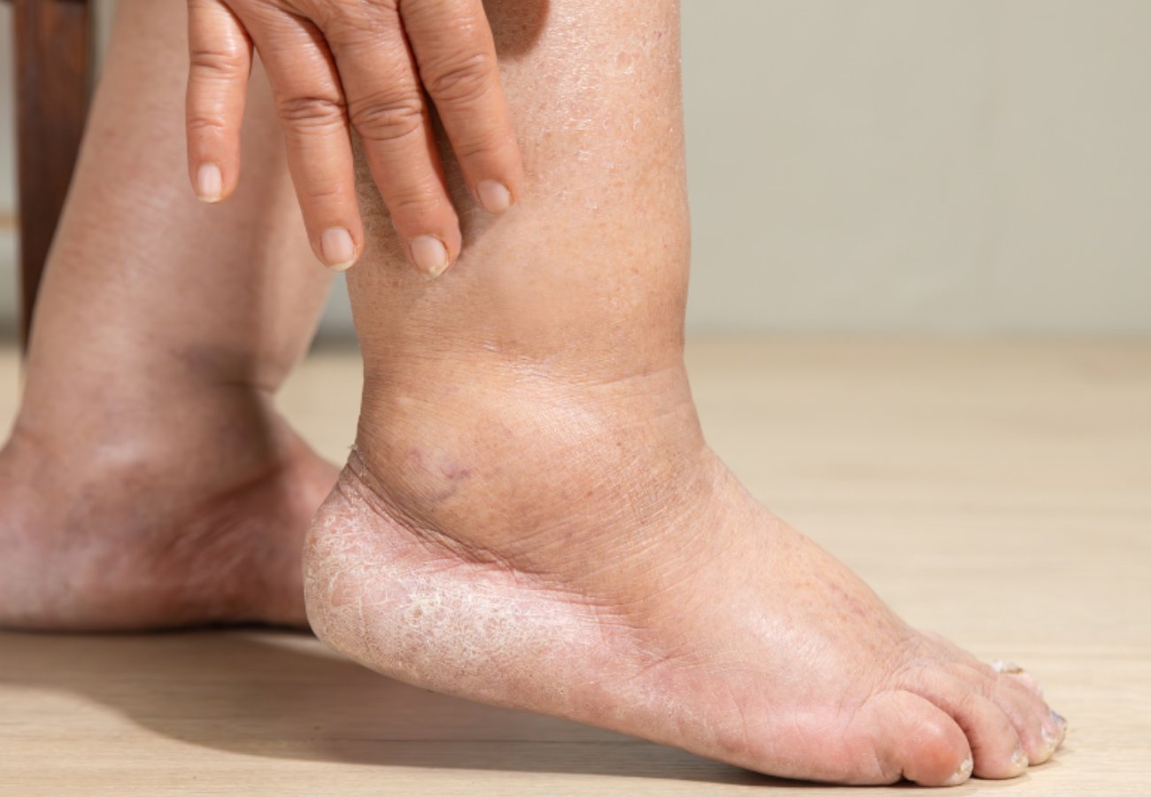 Λεμφοίδημα