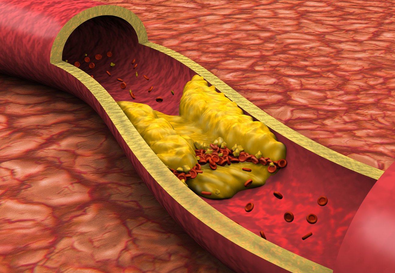 Περιφερική Αγγειοπάθεια