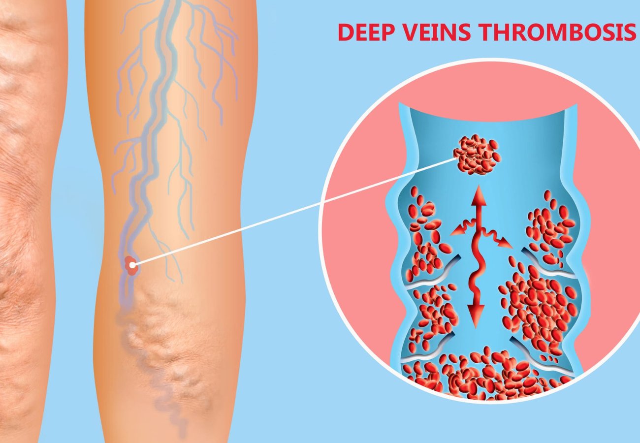 Φλεβική θρόμβωση